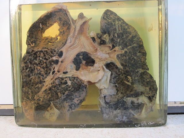 Silicosis News - "8.- Miner's lung with silicosis and tuberculosis" by Museomed